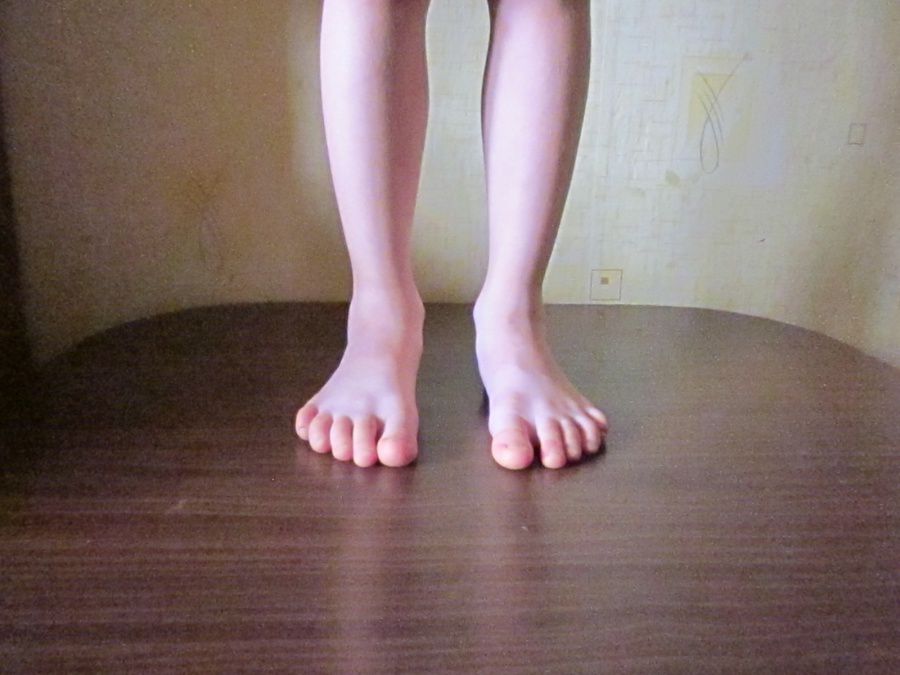 Вальгусная деформация стопы у детей фото