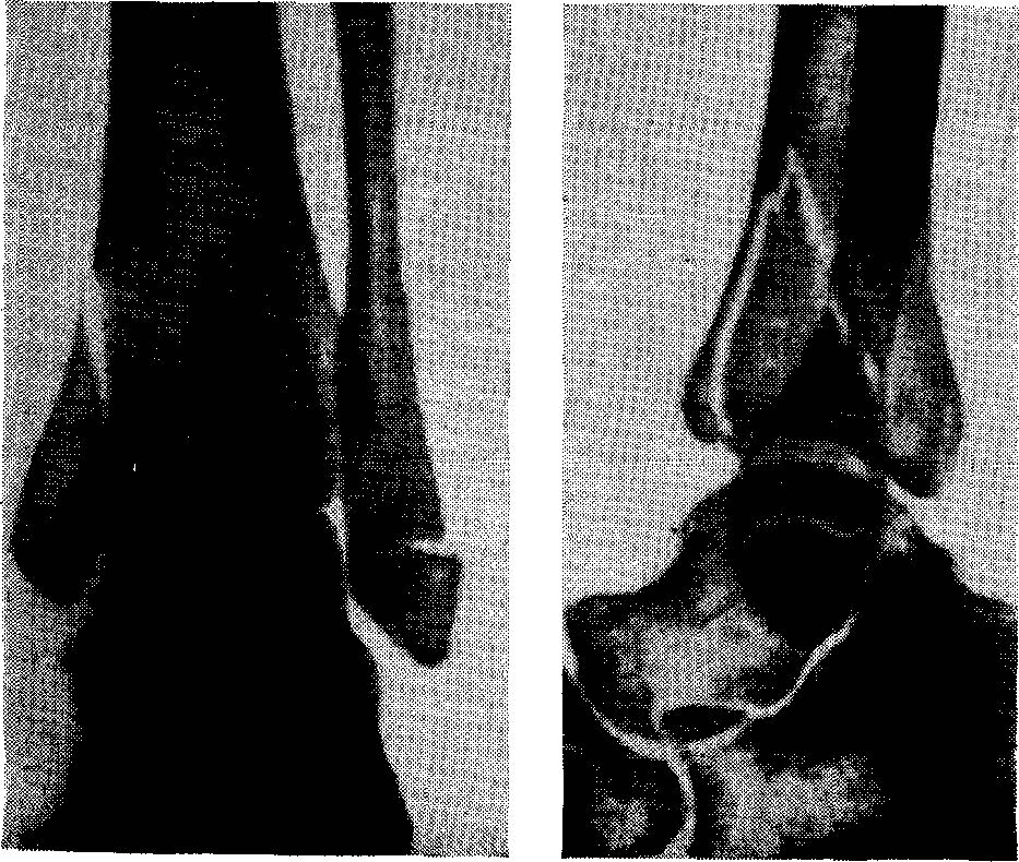 Перелом лодыжки без