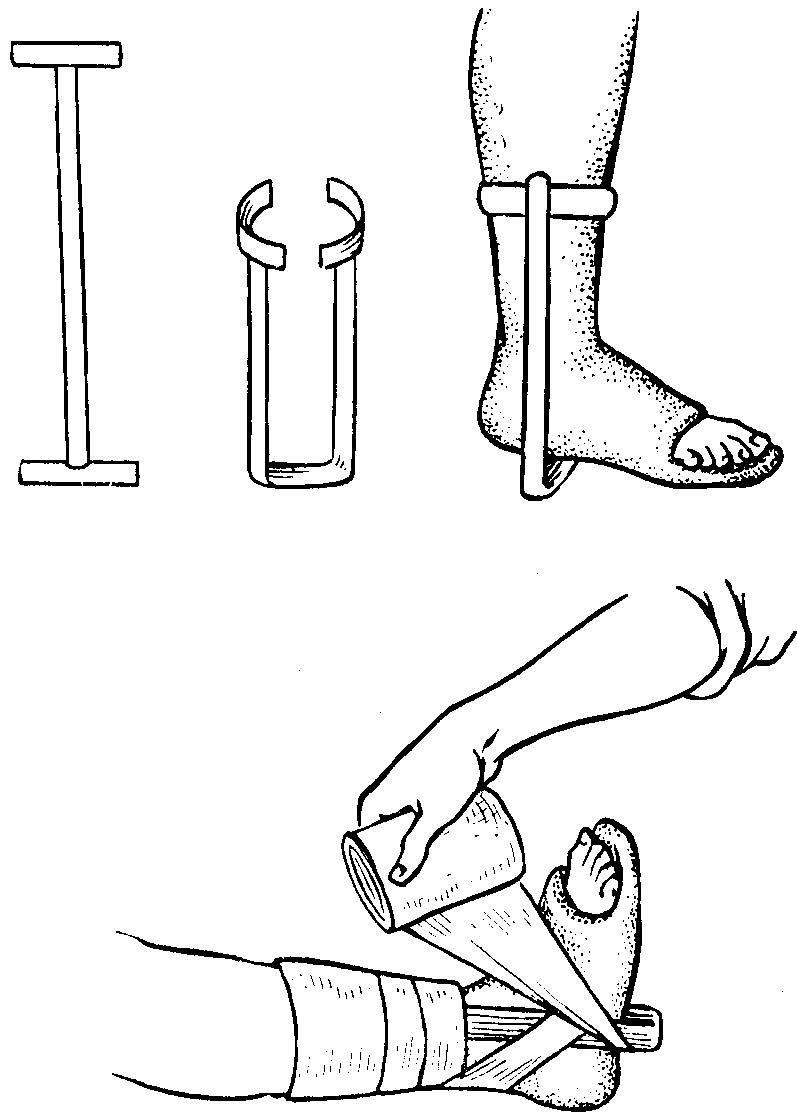 Гипсовые повязки шины. Гипсовая иммобилизация при переломе пяточной кости. Гипсовая повязка перелом лодыжки. Гипсовая иммобилизация голеностопного сустава. Перелом лодыжек гипсовая иммобилизация.