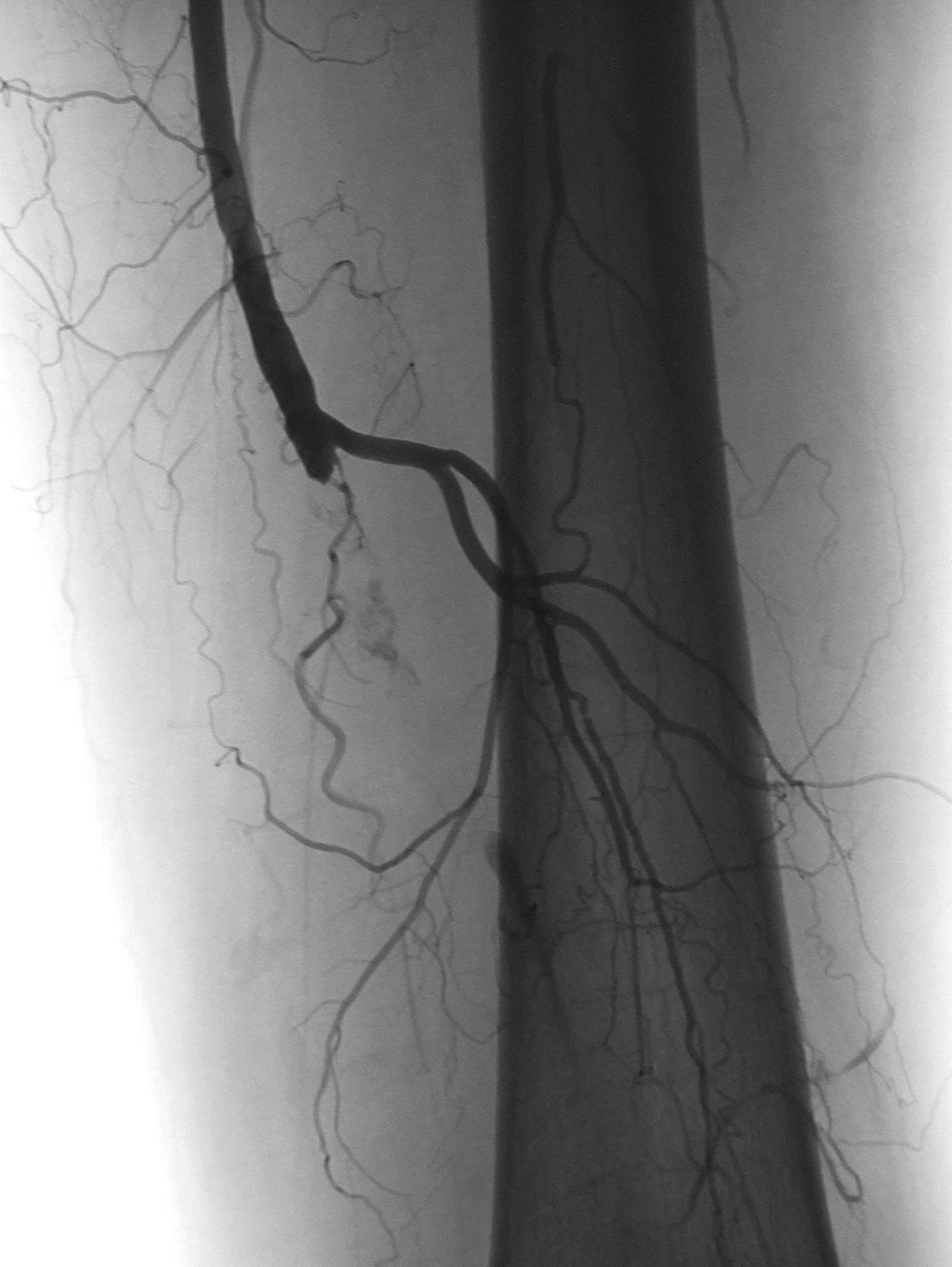Ангиография сосудов. Ангиография артерий нижних конечностей. Тромбоз нижних конечностей ангиография. Атеросклероз артерий нижних конечностей ангиография. Ангиограмма бедренной артерии.